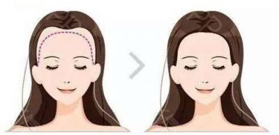 正常m型發際線是怎么樣的