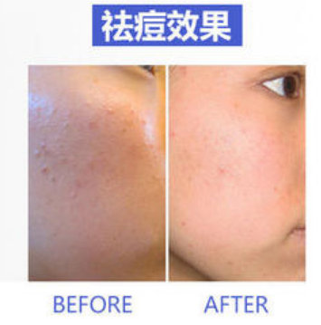 淺導美容有什么效果