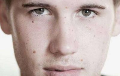男人臉上長黃褐斑是什么原因,能去掉嗎