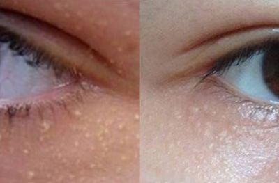 用護膚品起小米粒疙瘩怎么回事