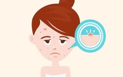 2337308711311 致痘的護膚品成分都有哪些