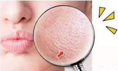 2343065911311 氯化鈉可以收縮毛孔粗大嗎