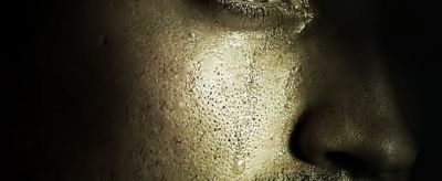 油性皮膚毛孔粗大怎么辦