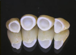 美容冠多少錢如何選擇