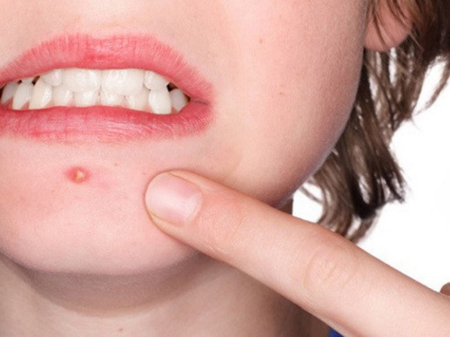 8_201948175441442_4 長痘的原因有哪些