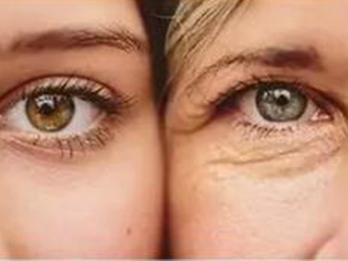 8_2019521155550218_4 如何除皺紋效果好