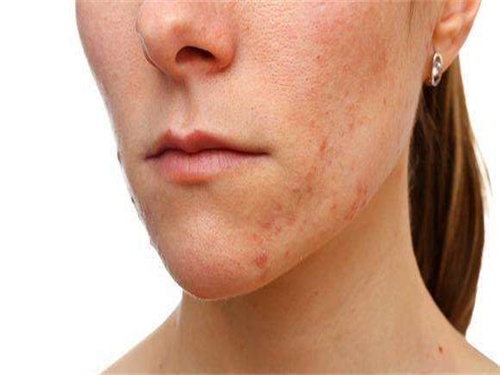 皮膚金屬過敏怎么辦