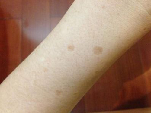 老年斑怎么去除小妙招